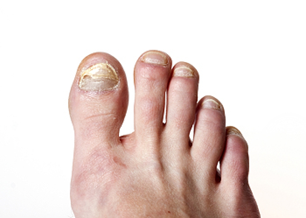 What Causes Toenail Fungus?