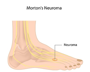 Everything You Should Know About Morton&#039;s Neuroma