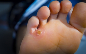 Causes of Corns