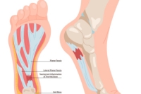 Easing the Pain of Plantar Fasciitis