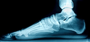 Two Categories of Flat Feet