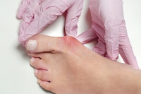 What Is the Medical Term for a Bunion?
