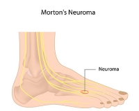 Possible Treatment of Morton’s Neuroma