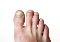 Are Fungal Nail Infections Common?