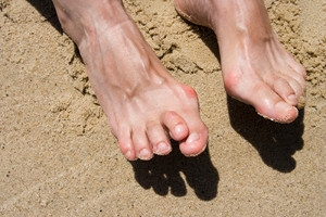 Why Some People Get Hammertoes