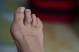 Facts About Hammertoes